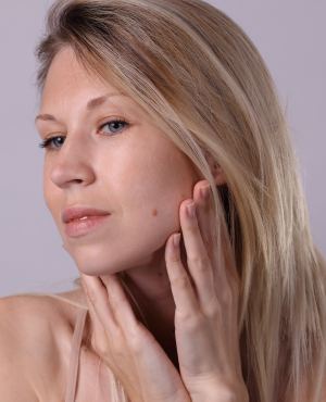 Skin Tag Removal Specialist Near Me in Stoughton, MA