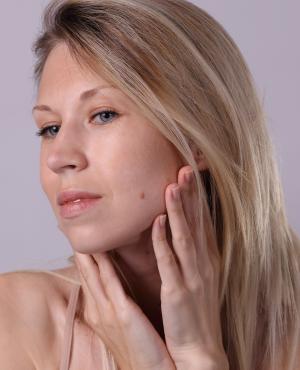Skin Tag Removal Specialist Near Me in Stoughton, MA